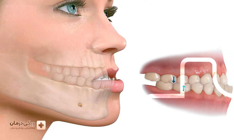 بهترین روش جراحی فک بالا جلو آمده چیست؟