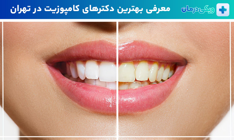 بهترین دکترهای کامپوزیت دندان در تهران