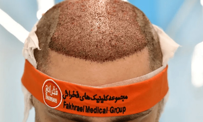 کاشت مو با تراکم بالا